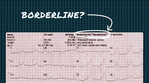 borderline ecg|borderline ecg mayo clinic.
